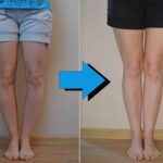 Langkah Pengobatan Kaki O atau Genu Varum