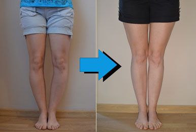 Langkah Pengobatan Kaki O atau Genu Varum