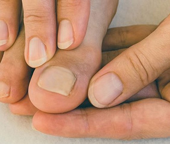 6 Gejala Kemunculan Jamur Kuku yang Harus Diperhatikan