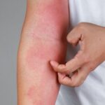 Fakta tentang Histamin yang Muncul sebagai Reaksi Alergi