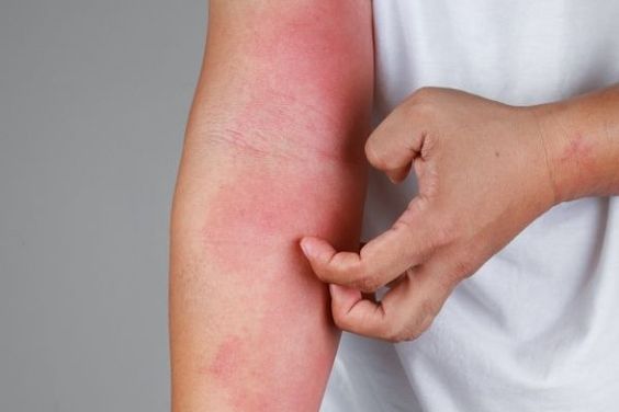 Fakta tentang Histamin yang Muncul sebagai Reaksi Alergi