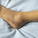 Penyebab Mata Kaki Bengkak dan Cara Pengobatannya