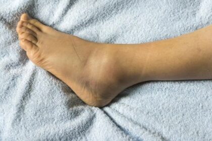 Penyebab Mata Kaki Bengkak dan Cara Pengobatannya