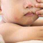Cara Mengobati Cacar Air pada Anak di Rumah