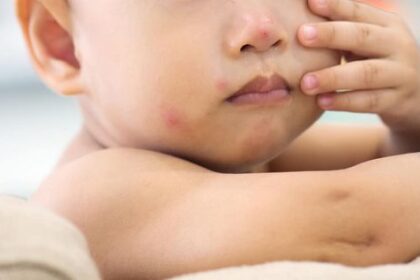 Cara Mengobati Cacar Air pada Anak di Rumah