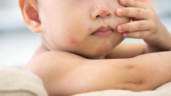 Cara Mengobati Cacar Air pada Anak di Rumah