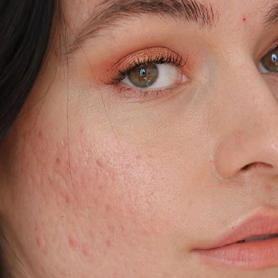 Rekomendasi Moisturizer Gel untuk Kulit Berminyak, Bikin Adem!