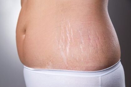 Mengenal Penyebab Stretch Mark dan Cara Mencegahnya
