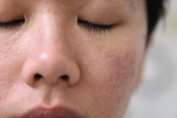 Mengenal Perbedaan Komedo Hitam dan Putih pada Wajah