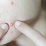 Cara Mengatasi Jerawat Pustula yang Perlu Kamu Ketahui!