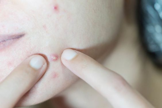 Cara Mengatasi Jerawat Pustula yang Perlu Kamu Ketahui!
