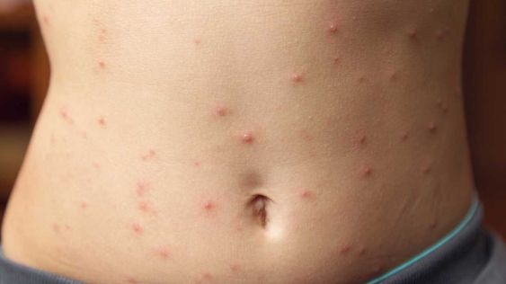 Mengenal Cacar Alaska, Gejala hingga Penyebabnya
