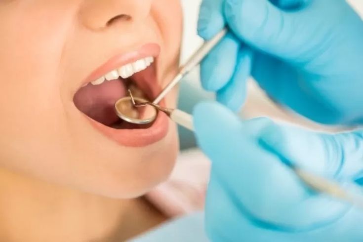 7 Penyebab Gigi Berlubang yang Perlu Diwaspadai