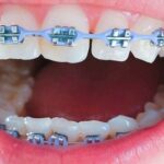 Behel vs Aligner untuk Merapikan Gigi, Lebih Baik Mana?