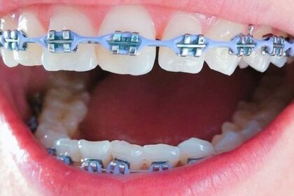 Behel vs Aligner untuk Merapikan Gigi, Lebih Baik Mana?