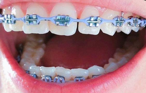 Behel vs Aligner untuk Merapikan Gigi, Lebih Baik Mana?