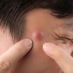 5 Penyebab Timbulnya Bisul pada Kulit
