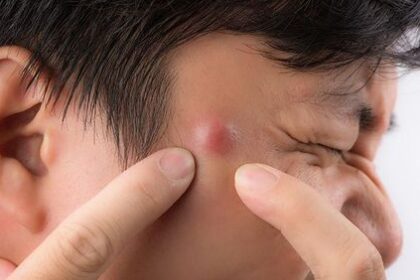 5 Penyebab Timbulnya Bisul pada Kulit