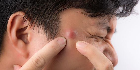 5 Penyebab Timbulnya Bisul pada Kulit