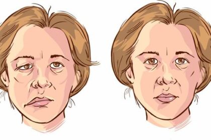 Terlalu Lama Terpapar Kipas Angin Timbulkan Gejala Bell's Palsy?