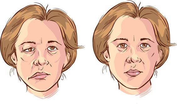 Terlalu Lama Terpapar Kipas Angin Timbulkan Gejala Bell's Palsy?
