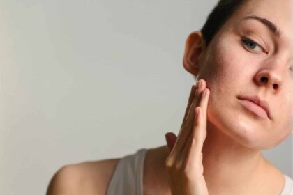 Rawat Jerawat Hormonal dengan 5 Cara Tepat, Sudah Tahu?