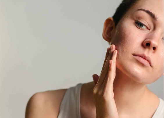 Rawat Jerawat Hormonal dengan 5 Cara Tepat, Sudah Tahu?