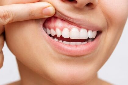 5 Kebiasaan Kecil yang Justru Dapat Merusak Gigimu!