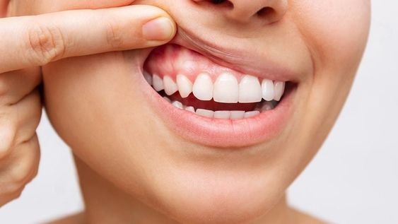 5 Kebiasaan Kecil yang Justru Dapat Merusak Gigimu!