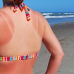Cara Menghilangkan Belang dan Sunburn Lebih Cepat
