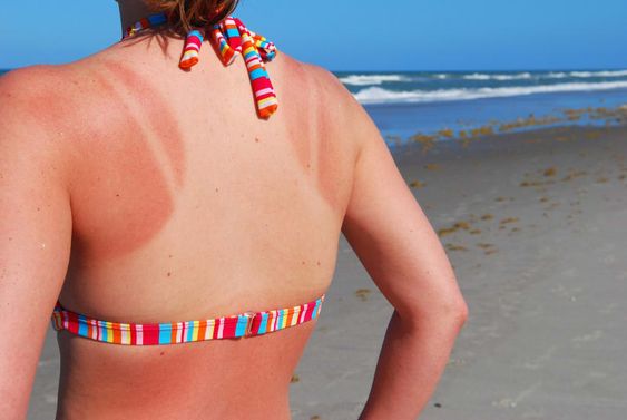 Cara Menghilangkan Belang dan Sunburn Lebih Cepat