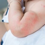 Mengenal Gejala Munculnya Scabies pada Bayi, Wajib Tahu!