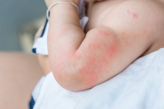 Mengenal Gejala Munculnya Scabies pada Bayi, Wajib Tahu!