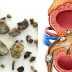 Alasan Batu Ginjal Bisa Berbentuk Seperti Jahe, Penasaran?