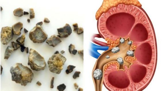 Alasan Batu Ginjal Bisa Berbentuk Seperti Jahe, Penasaran?