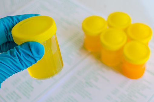 Warna Urine Ini Berisiko Picu Batu Ginjal, Wajib Tahu!