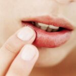 6 Langkah Sederhana Merawat Bibir Pecah-Pecah