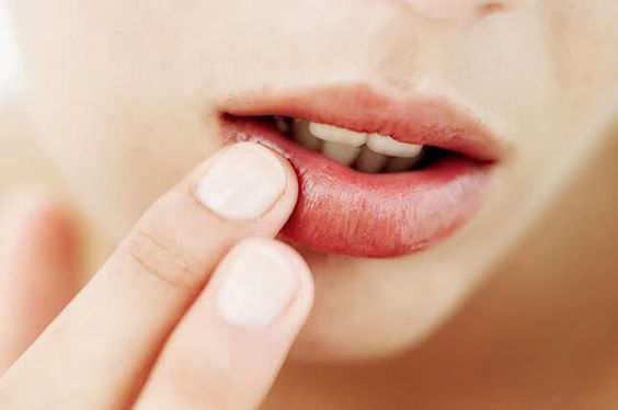 6 Langkah Sederhana Merawat Bibir Pecah-Pecah
