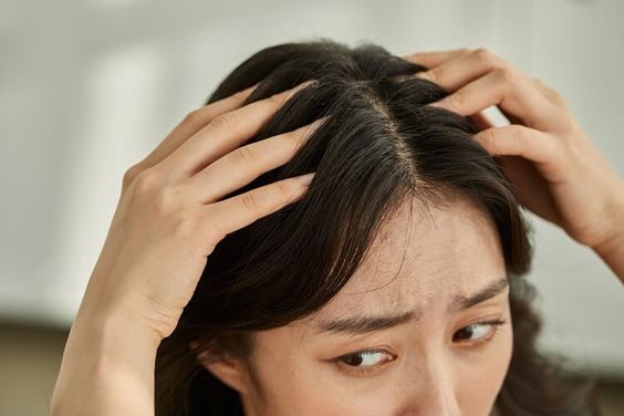 5 Kebiasaan Penyebab Gatal pada Rambut, Jangan Sepele!