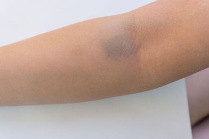 Kadar Leukosit Normal dan Kondisinya saat Tidak Normal
